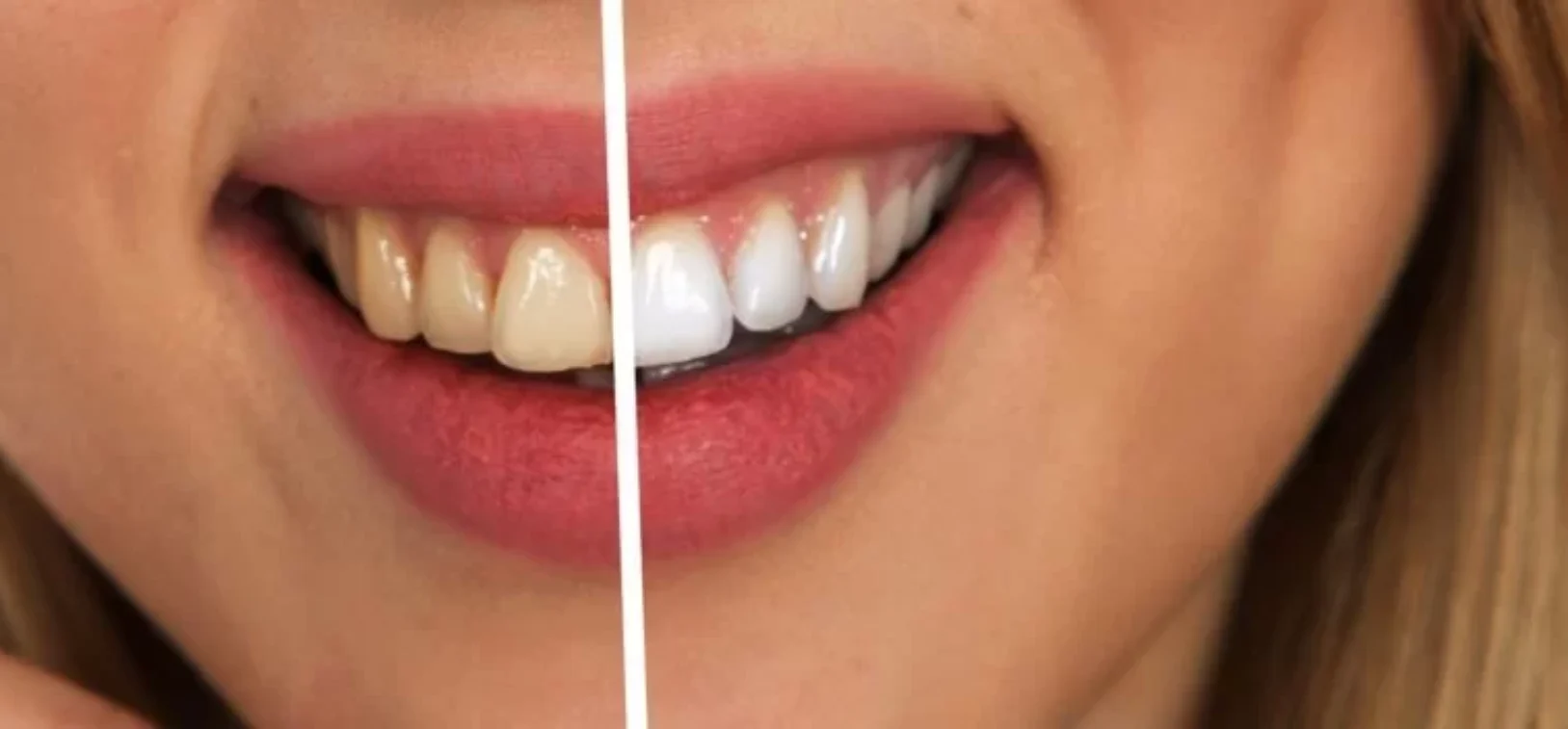 Knighton-Dental-Leicester-Teeth-Whitening-Blog-1030x352-1030x352 Blog inner thumb : Knighton Dental