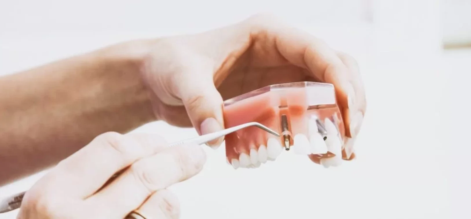 Knighton-Dental-Practice-Leicester-Dental-Implant-Blog-1030x453 Blog inner thumb : Knighton Dental