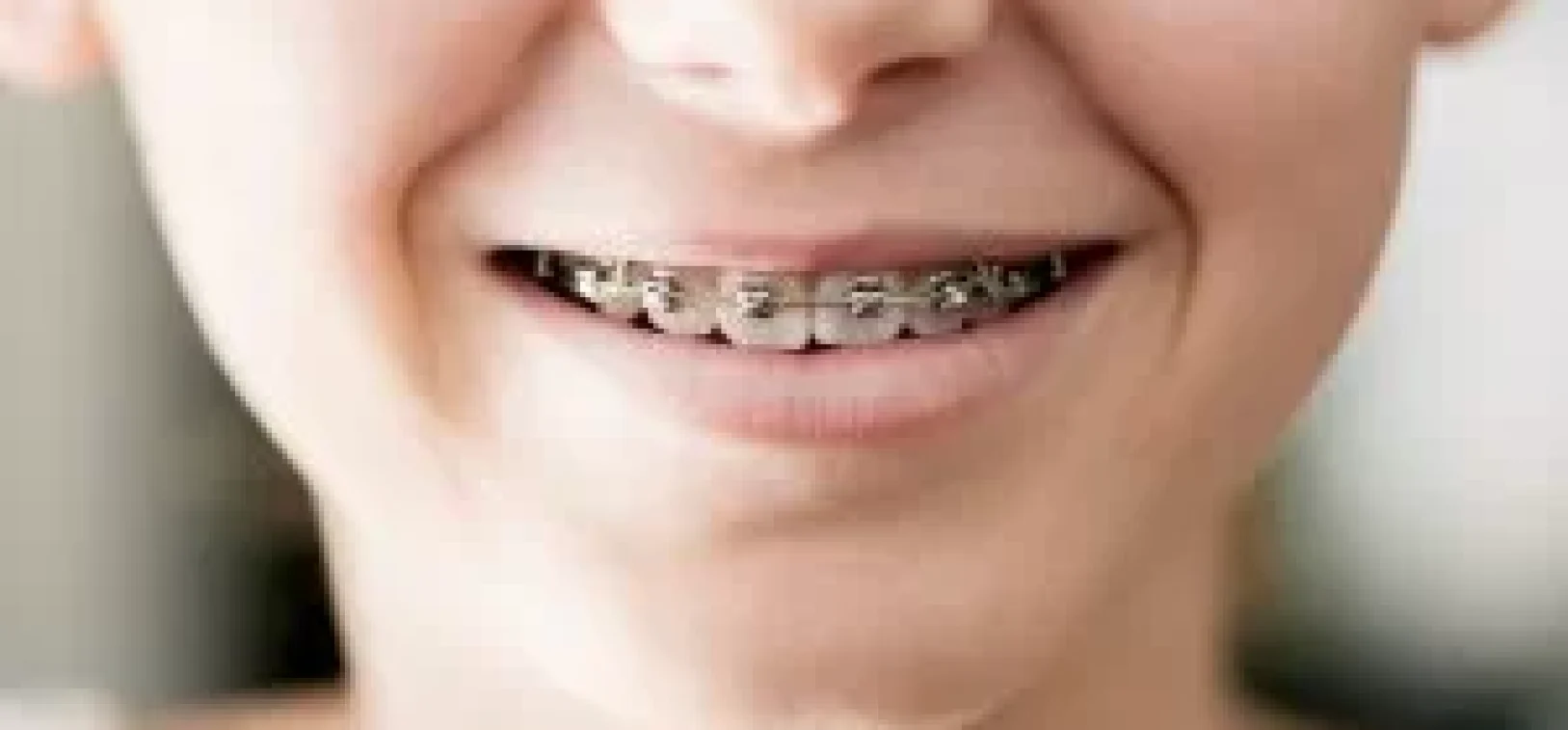 ortho-pic-300x180 Blog inner thumb : Knighton Dental