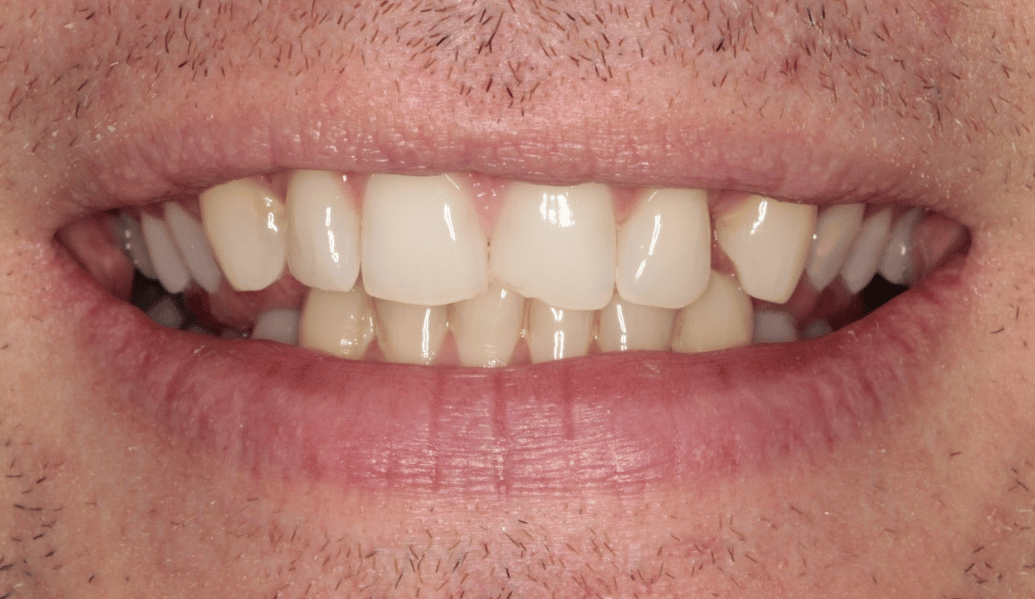 Before - Knighton Dental